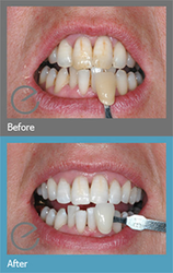 Tooth Whitening SuttonNear To Me - Dr. Suril Amin